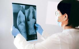 Vacuna Innovadora contra el Cáncer de Pulmón Inicia Ensayos Clínicos Globales