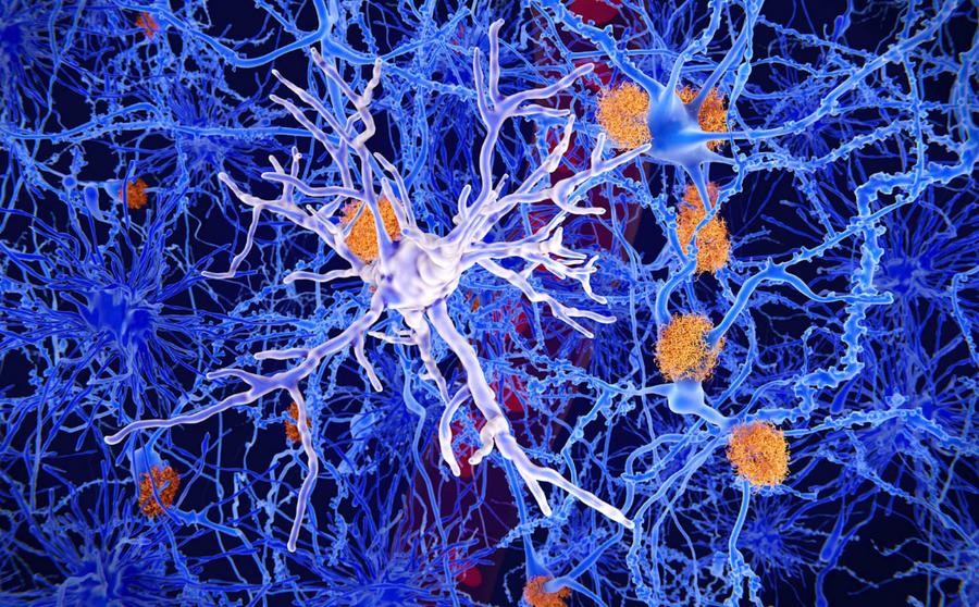 Cancer linked mutations in brain immune cells tied to Alzheimer’s disease