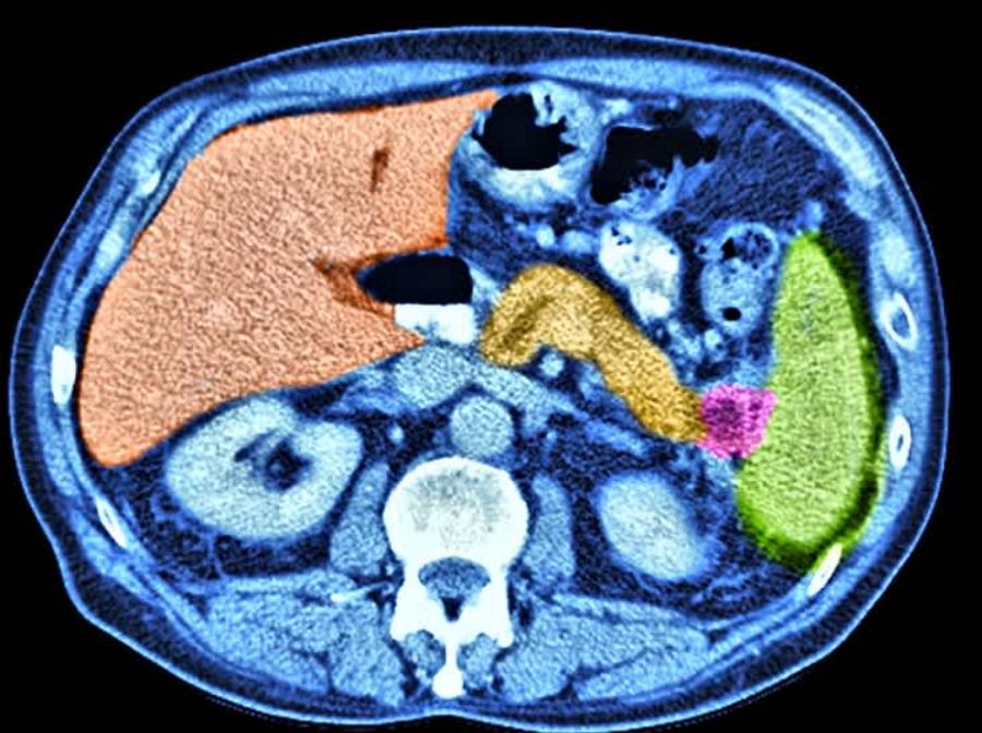 Ai model detects pancreatic cancer over a year before diagnosis