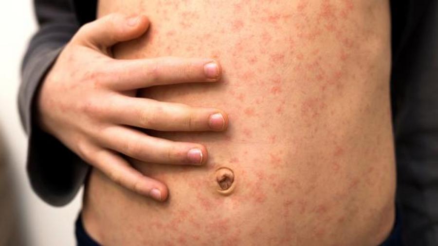 Bangladesh launches emergency vaccination campaign after measles outbreak kills nearly 100
