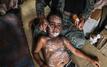 Gaza reports surge in chickenpox cases amid worsening health conditions