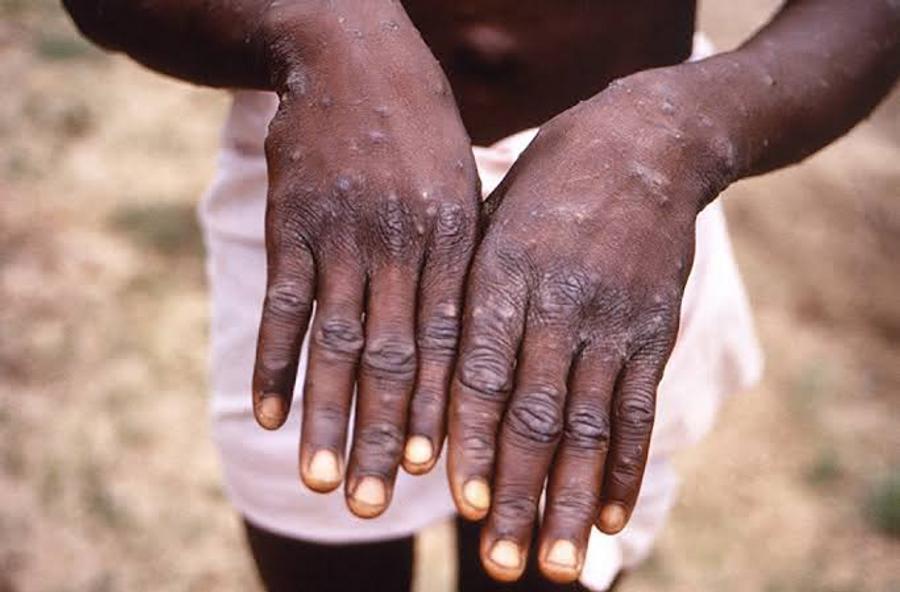 La Guinée-Bissau confirme son premier cas de Mpox et renforce son dispositif sanitaire