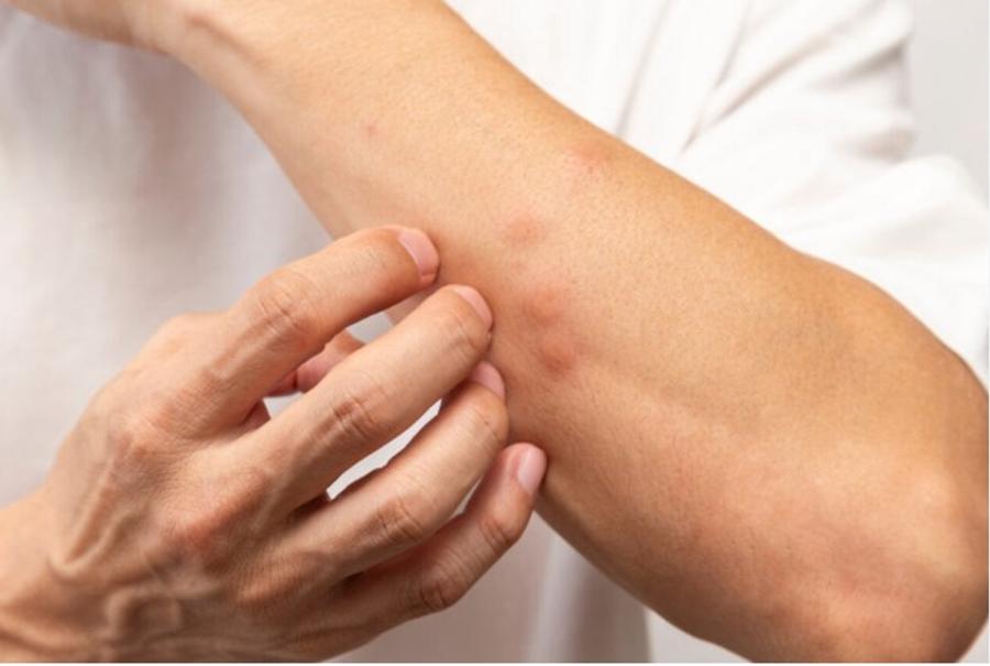 Mosquitos: las razones científicas que explican por qué eres más picado
