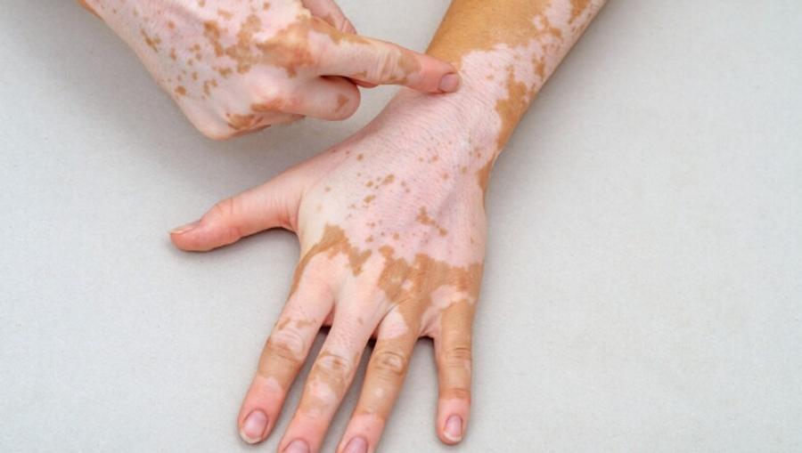 BAE, non-segmental vitiligo için ilk ağızdan tedaviyi onayladı