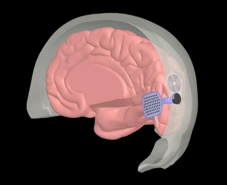 Cerveau et vision artificielle : l’IA ouvre une nouvelle voie pour les yeux bioniques
