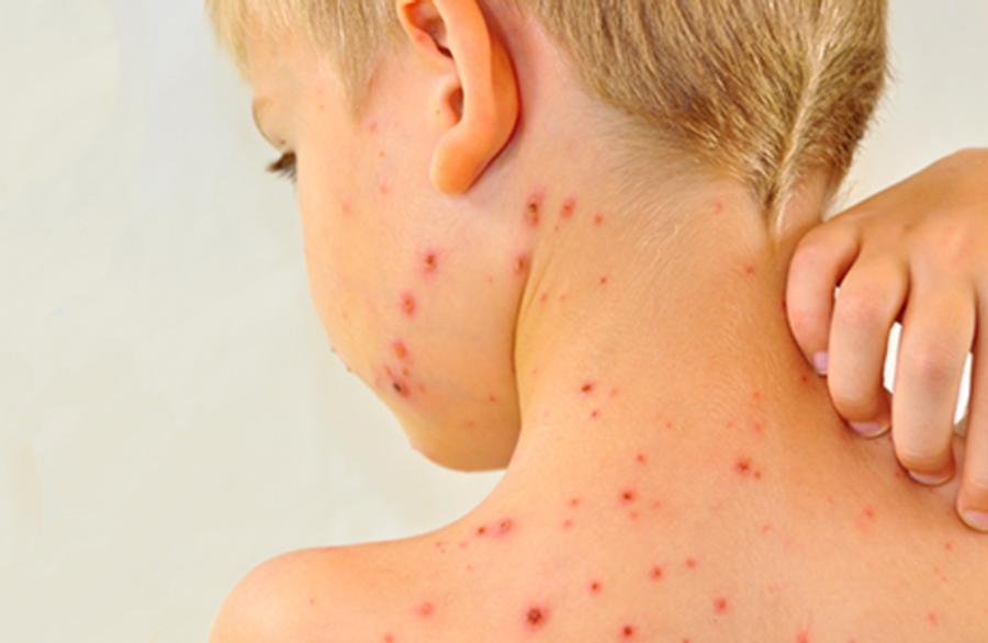 Pennsylvania measles outbreak surpasses 900 cases as four deaths are reported