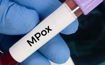 Mpox : l’Angola devient l’un des principaux foyers récents en Afrique