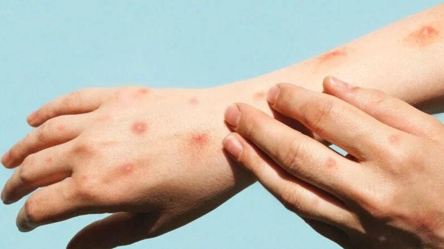 Africa lifts continental health emergency over Mpox