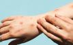 Africa lifts continental health emergency over Mpox
