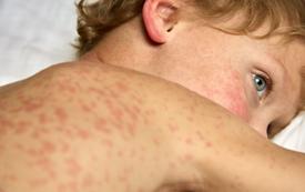 États-Unis : plus de 3 650 cas de rougeole en 2026, un niveau inédit depuis 1991