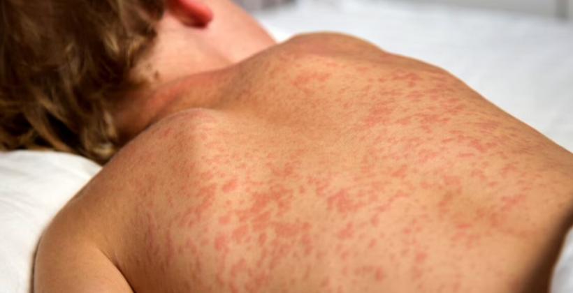 US reports more than 3,650 measles cases in 2026, the highest level since 1991