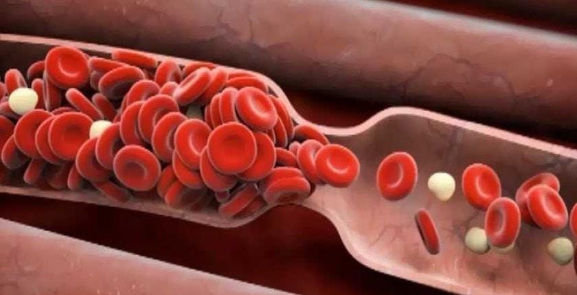 أحدث دراسات كورونا.. الفيروس التاجي قد يسبب جلطة دموية