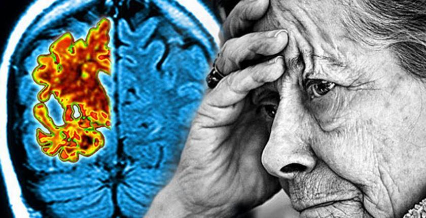 دراسة كندية تكشف بروتين في دماغ الإنسان يحميه من ألزهايمر
