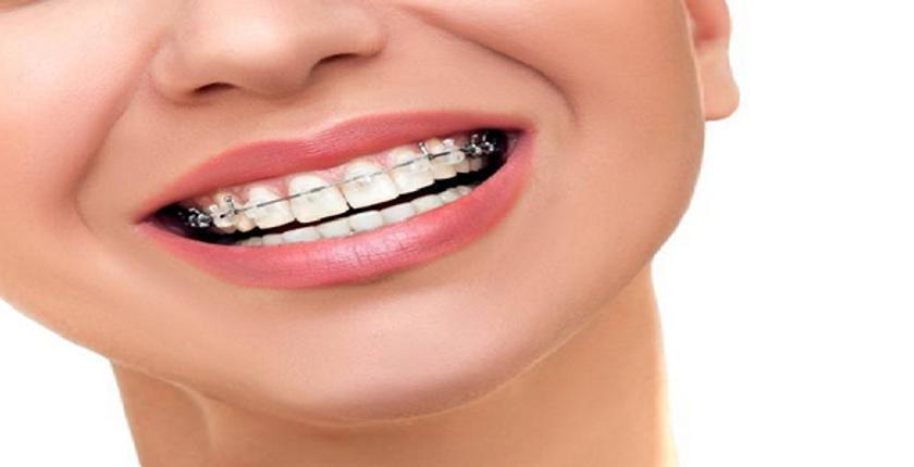 كيفية التعامل مع آلام تقويم الأسنان 