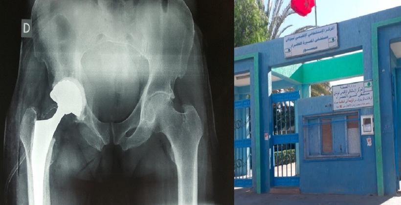 نجاح عملية استبدال كلي لورك رجل خمسيني بميسور