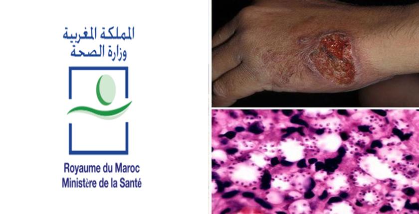وزارة الصحة تسجل أزيد من 800 حالة إصابة بمرض اللشمانيا بالمملكة