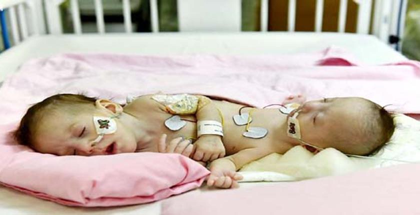 انطلاق عملية فصل التوأم السيامي الفلسطيني "فرح وحنين" + ألبوم صور
